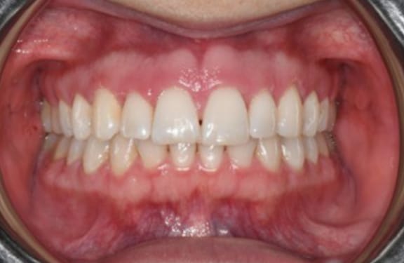 After esthetic crown lengthening showing improved tooth visibility and balanced gum line