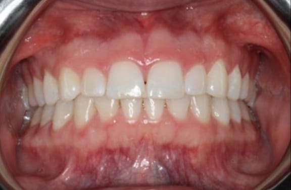 Before esthetic crown lengthening showing excessive gum coverage of teeth