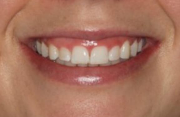 Before view of esthetic crown lengthening case with uneven gum line