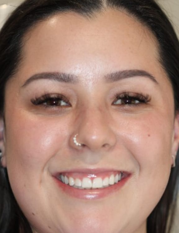 Before esthetic crown lengthening showing overall smile appearance with uneven gum line