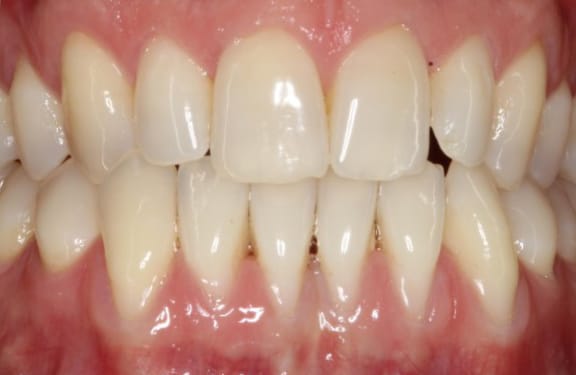 Close-up before gum grafting showing localized gum recession around the tooth