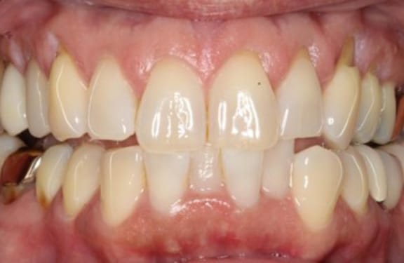 Close-up before gum grafting showing advanced gum recession affecting multiple teeth