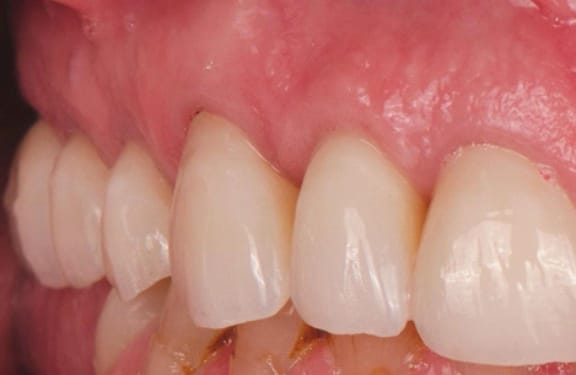 After dental implant treatment showing two front teeth replaced with implant-supported restorations