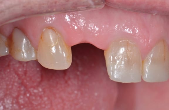 Before dental implant treatment showing a single missing tooth prior to restoration