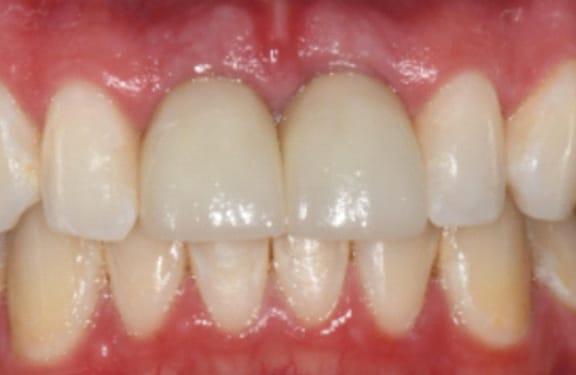 After dental implant treatment showing two front teeth replaced with implant-supported restorations
