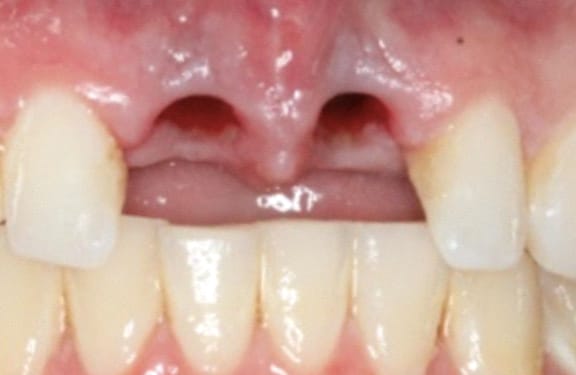 Before dental implant treatment showing two missing front teeth affecting smile appearance