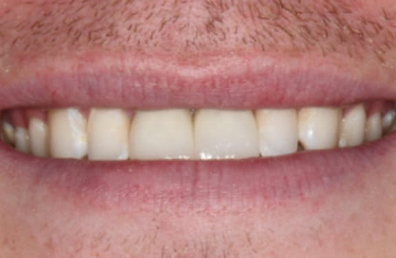 After view of dental implant case showing restored front teeth with implant crowns