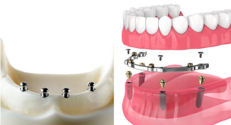 Dental implant supported-denture ball attachments are on the left, and the bar attachment is on the right.